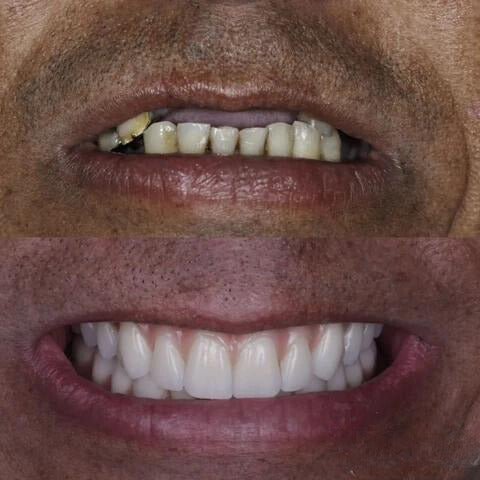 Dentadura de Silicone Ajustavél e Adaptativa