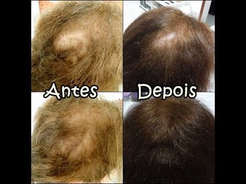 Boné de LED Terapia Capilar Anti Queda CAPILUS MAX™ Capellux