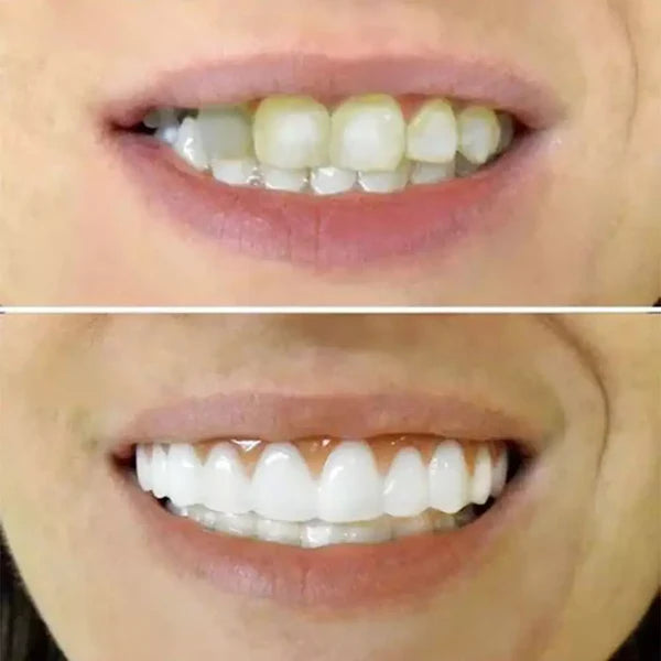 Dentadura de Silicone Ajustavél e Adaptativa
